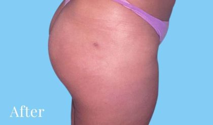 Buttock Augmentation Before & After Patient #2387