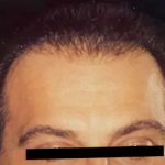 Hair Restoration Before & After Patient #2743