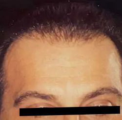 Hair Restoration Before & After Patient #2743