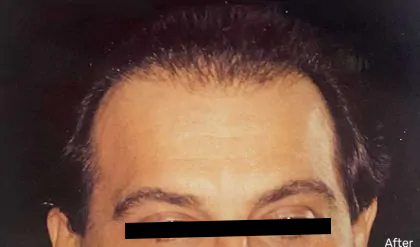 Hair Restoration Before & After Patient #2743