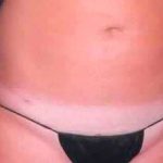 Liposuction Before & After Patient #2823