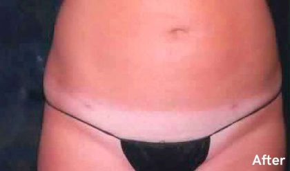 Liposuction Before & After Patient #2823