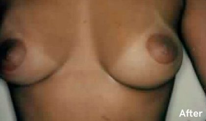 Breast Augmentation Before & After Patient #2202