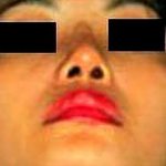Rhinoplasty Before & After Patient #2961