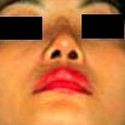 Rhinoplasty Before & After Patient #2961