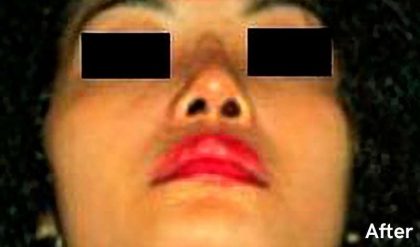 Rhinoplasty Before & After Patient #2961