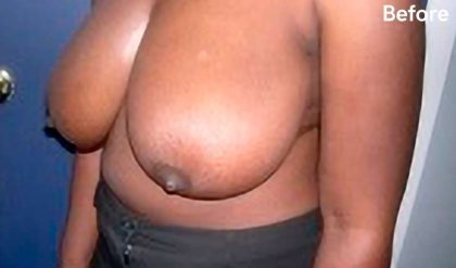 Breast Reduction Before & After Patient #2312