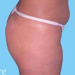 Buttock Augmentation Before & After Patient #2387