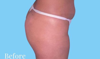 Buttock Augmentation Before & After Patient #2387