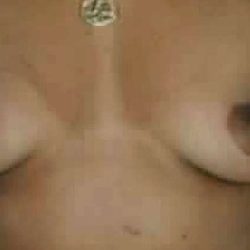 Breast Augmentation Before & After Patient #2202
