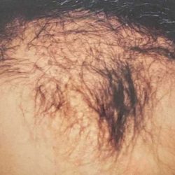 Hair Restoration Before & After Patient #2743