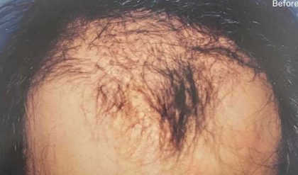 Hair Restoration Before & After Patient #2743
