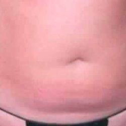 Liposuction Before & After Patient #2823