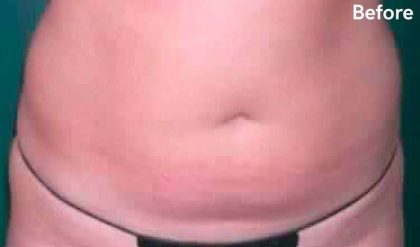 Liposuction Before & After Patient #2823