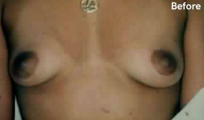 Breast Augmentation Before & After Patient #2202