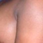 Breast Reduction Before & After Patient #2303