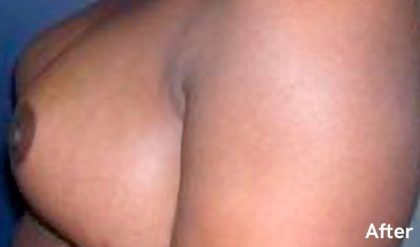 Breast Reduction Before & After Patient #2303