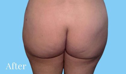 Buttock Augmentation Before & After Patient #2378