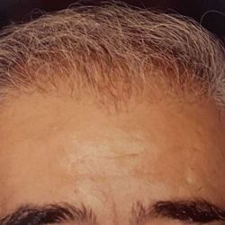 Hair Restoration Before & After Patient #2734