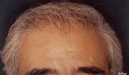 Hair Restoration Before & After Patient #2734