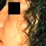 Rhinoplasty Before & After Patient #2952