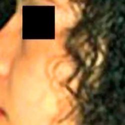 Rhinoplasty Before & After Patient #2952