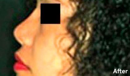 Rhinoplasty Before & After Patient #2952