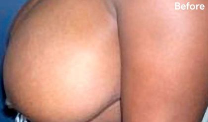 Breast Reduction Before & After Patient #2303