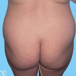 Buttock Augmentation Before & After Patient #2378