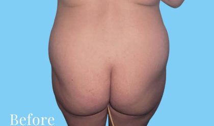Buttock Augmentation Before & After Patient #2378