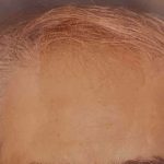 Hair Restoration Before & After Patient #2734