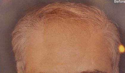 Hair Restoration Before & After Patient #2734