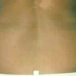 Liposuction Before & After Patient #2817
