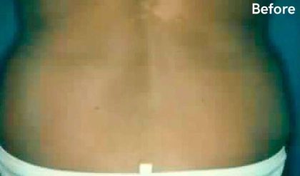 Liposuction Before & After Patient #2817