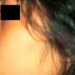 Rhinoplasty Before & After Patient #2952