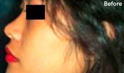 Rhinoplasty Before & After Patient #2952