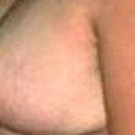 Breast Reduction Before & After Patient #2346