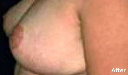 Breast Reduction Before & After Patient #2346