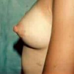 Breast Augmentation Before & After Patient #2236