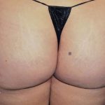 Buttock Augmentation Before & After Patient #2429