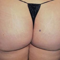 Buttock Augmentation Before & After Patient #2429