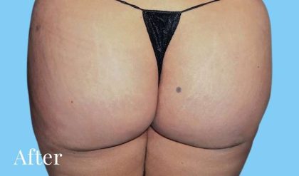 Buttock Augmentation Before & After Patient #2429