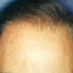 Hair Restoration Before & After Patient #2778