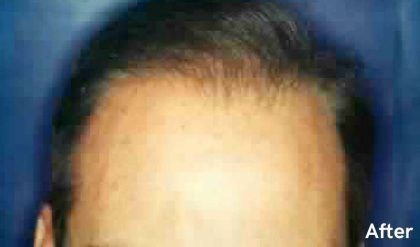 Hair Restoration Before & After Patient #2778