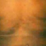 Liposuction Before & After Patient #2861