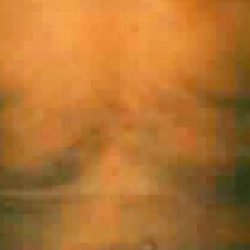 Liposuction Before & After Patient #2861
