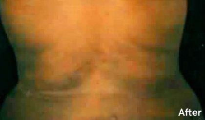 Liposuction Before & After Patient #2861