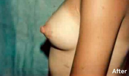 Breast Augmentation Before & After Patient #2236