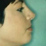 Rhinoplasty Before & After Patient #2985