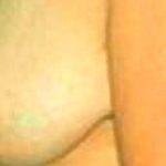 Breast Reduction Before & After Patient #2346